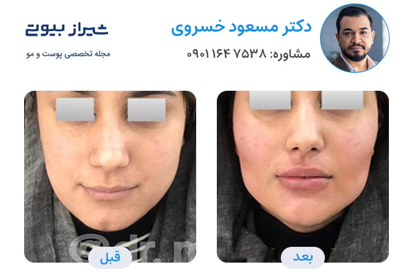 تزریق فول فیس در شیراز - دکتر مسعود خسروی - تصاویر قبل و بعد