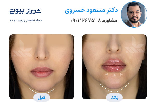 تزریق فول فیس در شیراز - دکتر مسعود خسروی - تصاویر قبل و بعد