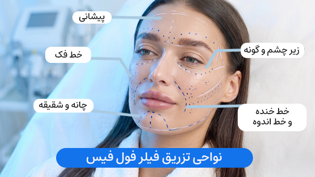نواحی تزریق فیلر فول فیس