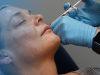 تزریق فول فیس در شیراز