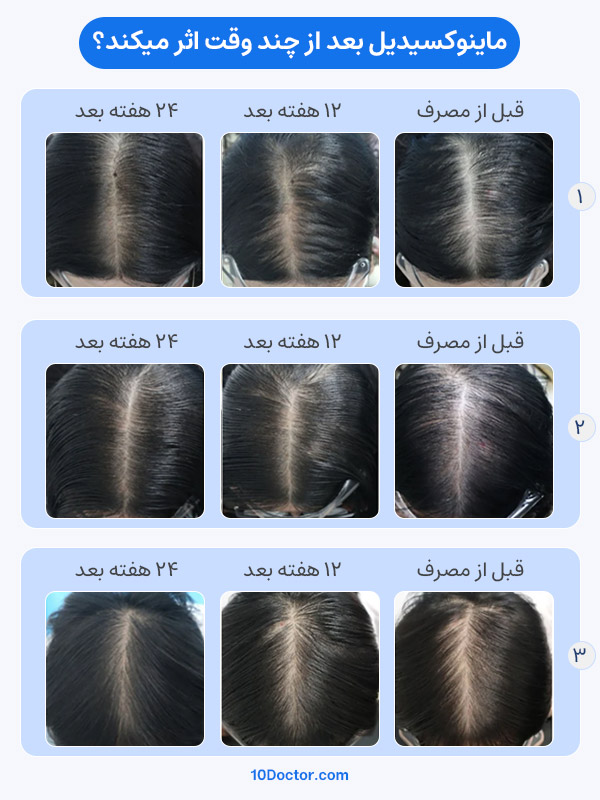 ماینوکسیدیل بعد از چند وقت اثر میکند؟ - تصاویر قبل ماینوکسیدیل - ۱۲ هفته بعد - ۲۴ هفته بعد