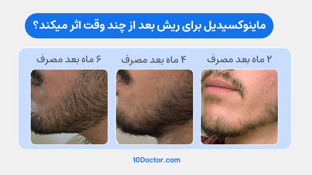 ماینوکسیدیل برای ریش بعد از چند وقت اثر میکند؟ - تصاویر ۲ ماه - ۴ ماه و ۶ ماه بعد از مصرف ماینوکسیدل برای ریش