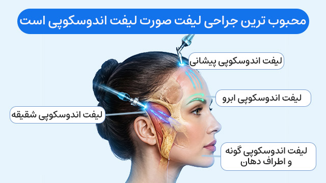 محبوب ترین جراحی لیفت صورت ← لیفت آندوسکوپی