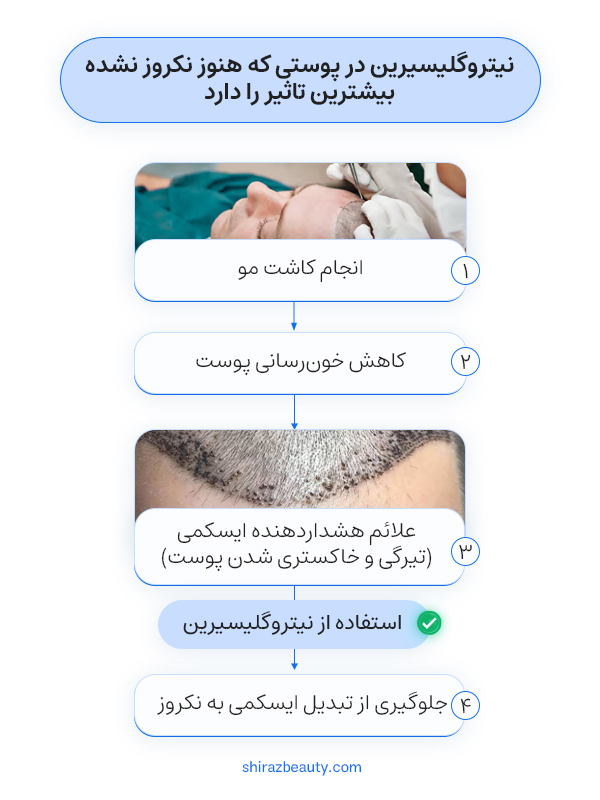 نیتروگلیسیرین در پوستی که هنوز نکروز نشده بیشترین تاثیر را دارد. 