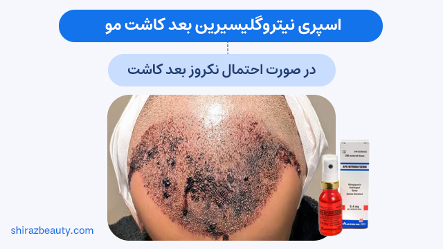 اسپری نیتروگلیسیرین بعد کاشت مو ← در صورت احتمال نکروز بعد کاشت