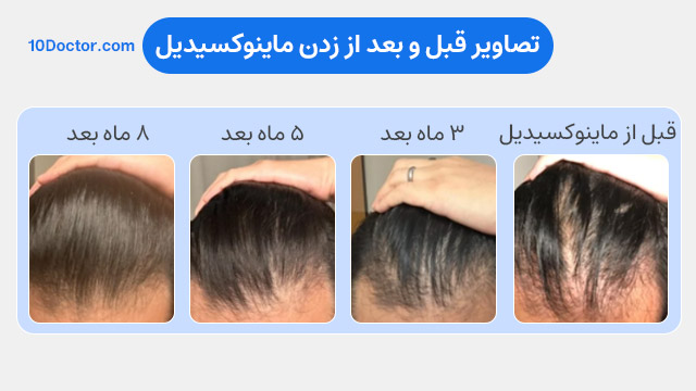 عکس های قبل از ماینوکسیدیل - سه ماه بعد - پنج ماه بعد - هشت ماه بعد