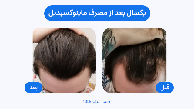 عکس های یکسال بعد از مصرف ماینوکسیدیل