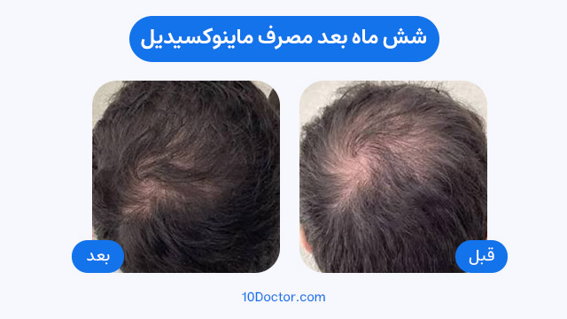 عکس های شش ماه بعد مصرف ماینوکسیدیل
