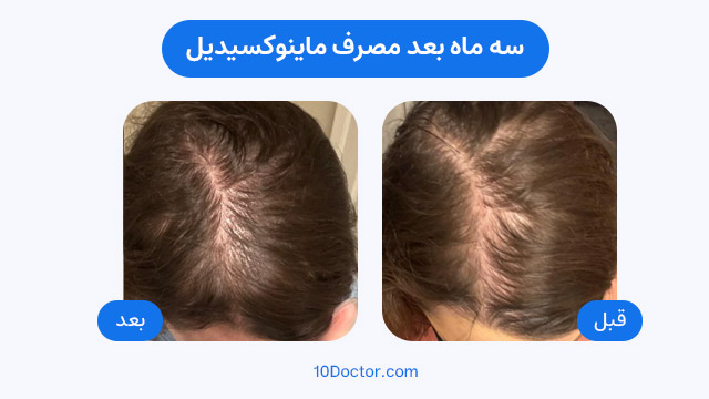 عکس های سه ماه بعد مصرف ماینوکسیدیل