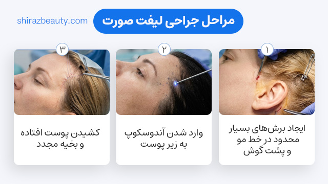 مراحل جراحی لیفت صورت