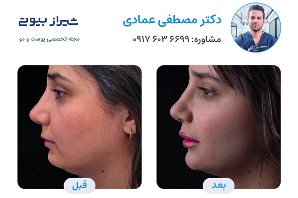 تزریق فول فیس در شیراز - دکتر مصطفی عمادی - تصاویر قبل و بعد