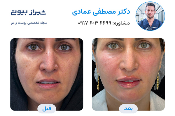 تزریق فول فیس در شیراز - دکتر مصطفی عمادی - تصاویر قبل و بعد
